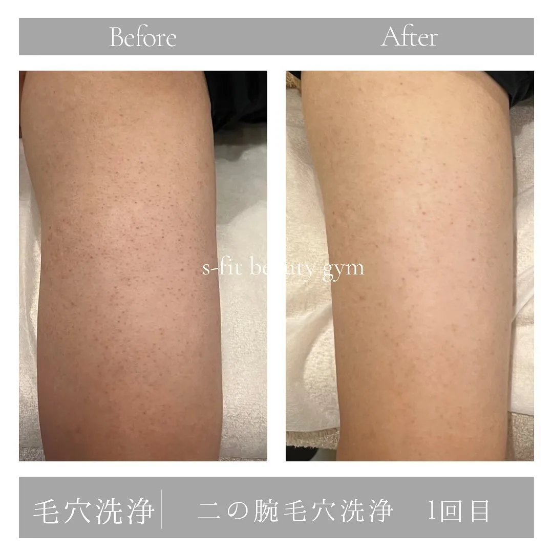 【新メニュー】ボディ毛穴洗浄✨✨